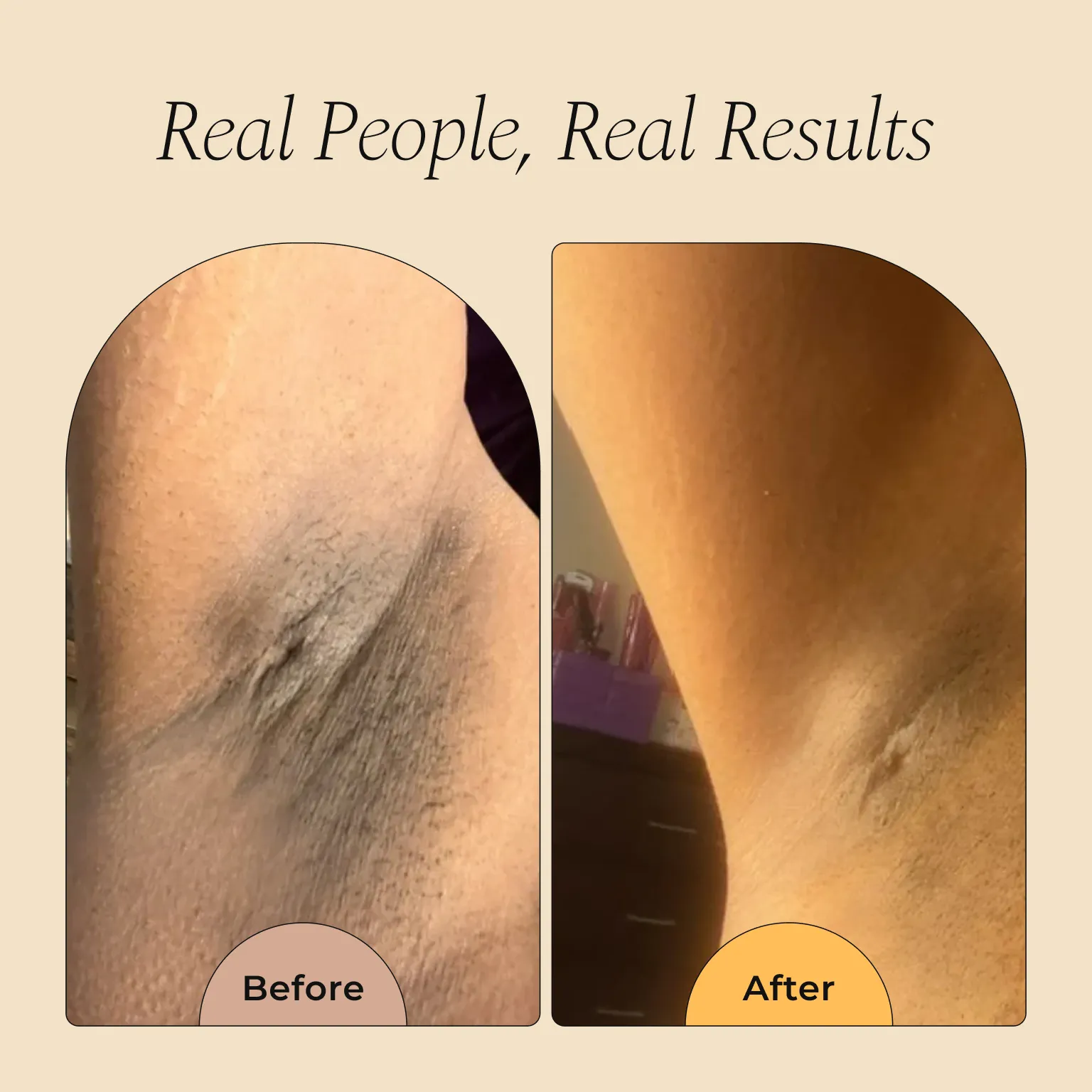 Roller Remover (ingrowns and dark spots) - Image 4
